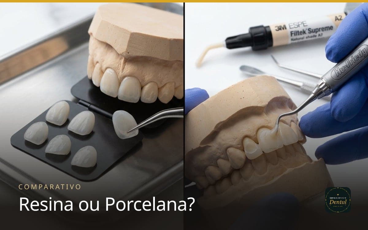 Faceta de Resina ou Porcelana? Compare Preço, Durabilidade e Cor