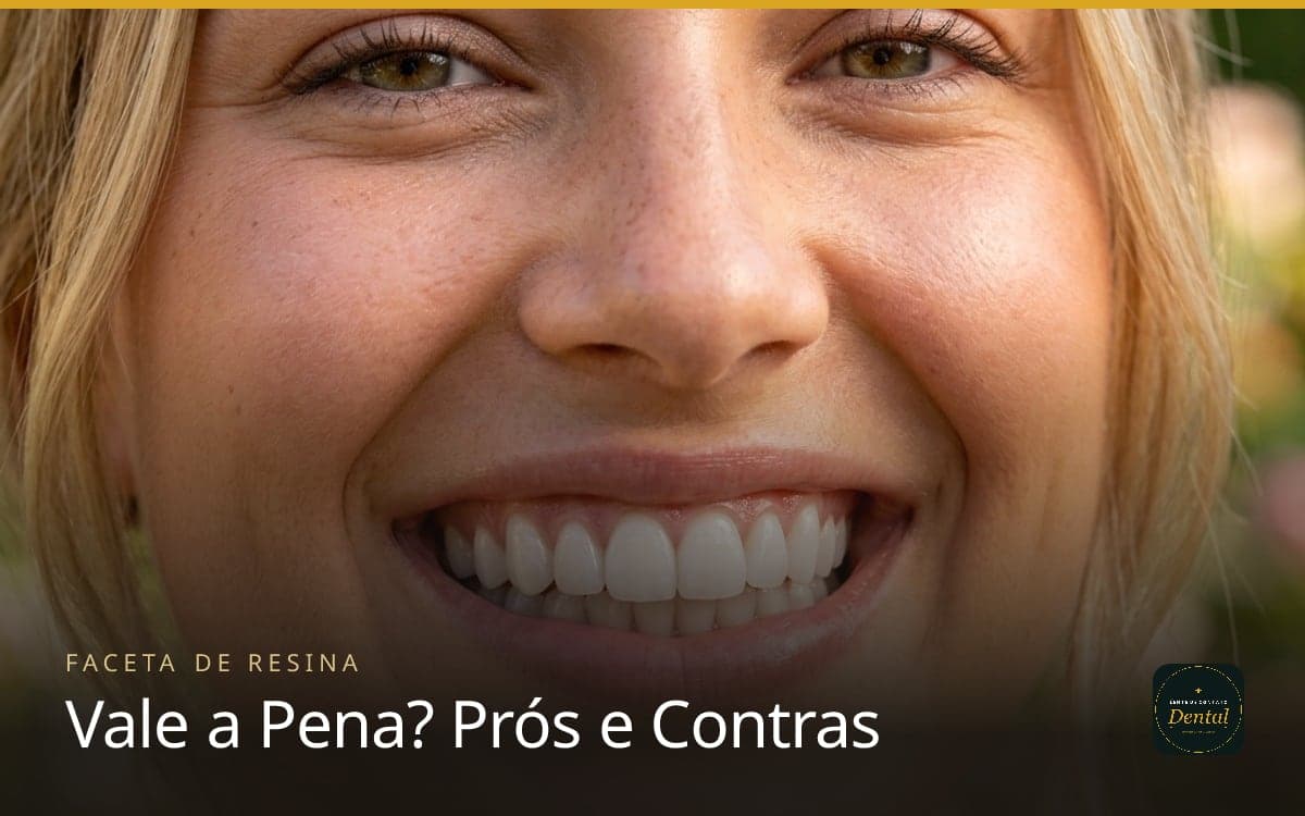 Facetas de Resina Valem a Pena? Prós, Contras e Durabilidade Real