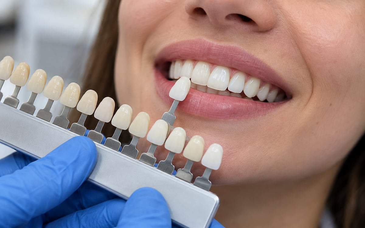 Dentista compara a escala de cor com os dentes da paciente para registrar o tom antes do tratamento